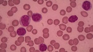 MSK Investigators Understanding Leukemia Resistance To Chemotherapy