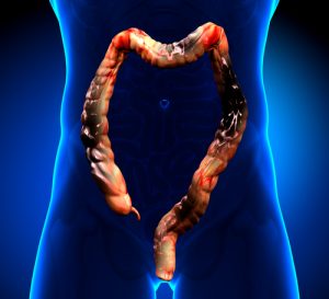 New Study Showing Rising Colorectal Cancer Rates in Young People